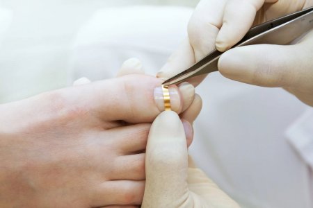 Лечение вросшего ногтя на ноге в алматы